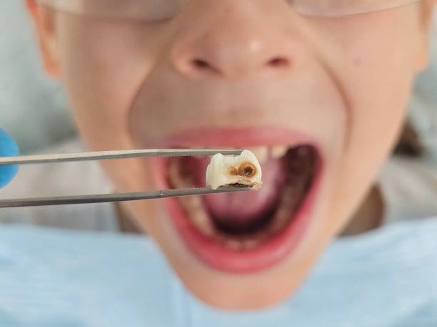 Best After-Hours Emergency Dentist in Purdy, MO